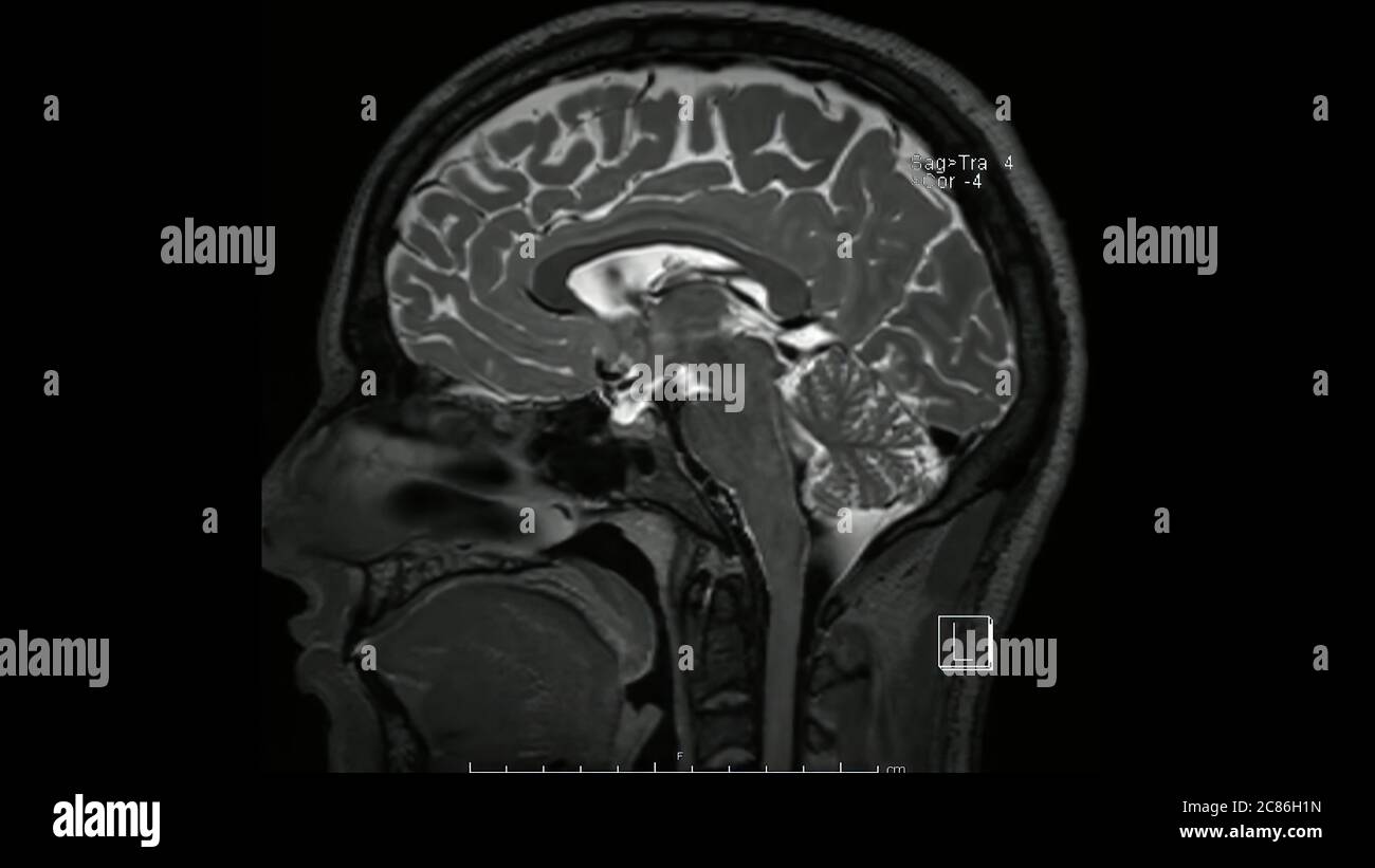 Magnetresonanzbilder des Gehirns (MRT-Gehirn) sagittale T2-gewichtete Sequenz im Cine-Modus, die normale Anatomie zeigt Stockfoto