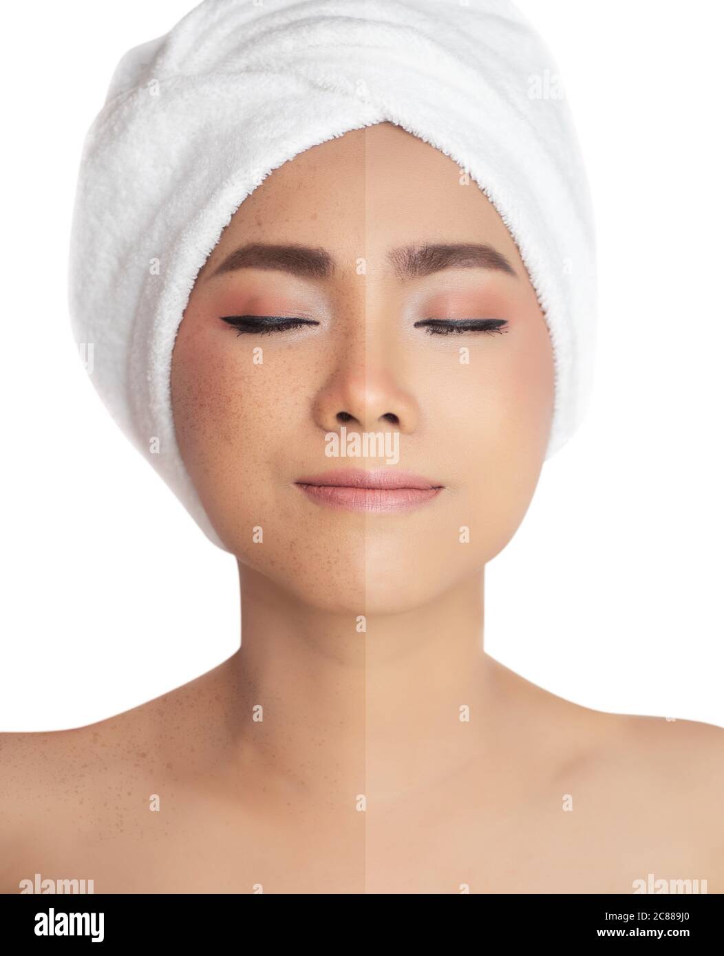 Bilder vor und nach retuschieren Sommersprossen verglichen , Sommersprossen Pigmentfleck Entfernen und Heilung vor und nach der Laserbehandlung auf asiatische Frau Gesicht Stockfoto
