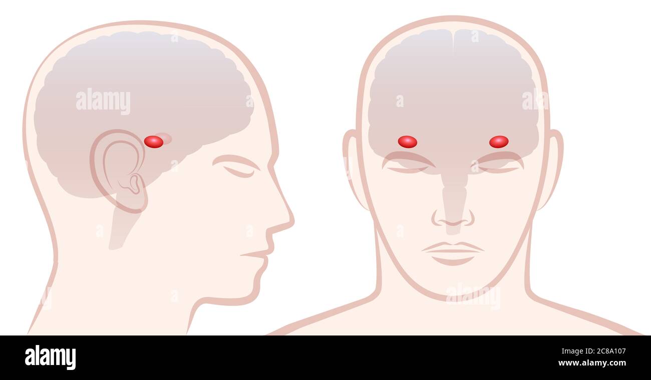 Amygdala. Profil und Frontalansicht mit Lage des Paares von Amigdalas im menschlichen Gehirn - Abbildung auf weißem Hintergrund. Stockfoto