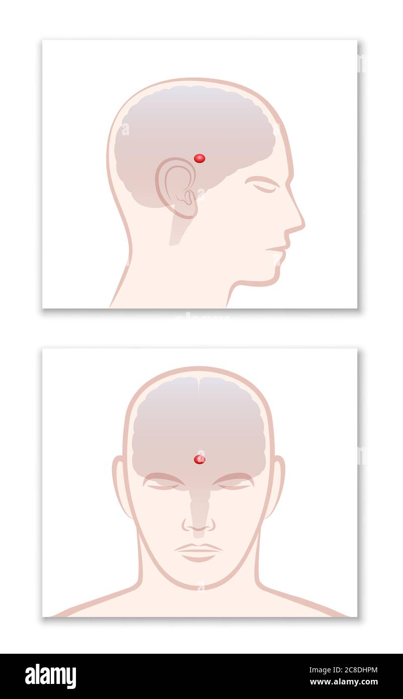 Zirbeldrüse. Profil und Frontalansicht mit Lage im menschlichen Gehirn - Abbildung auf weißem Hintergrund. Stockfoto
