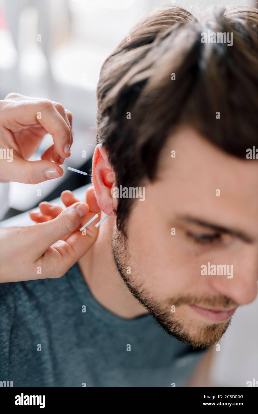 Traditionelle Chinesische Medizin, TCM, Akupunktur, Ohr mit Akupunkturnadel während der Behandlung Stockfoto