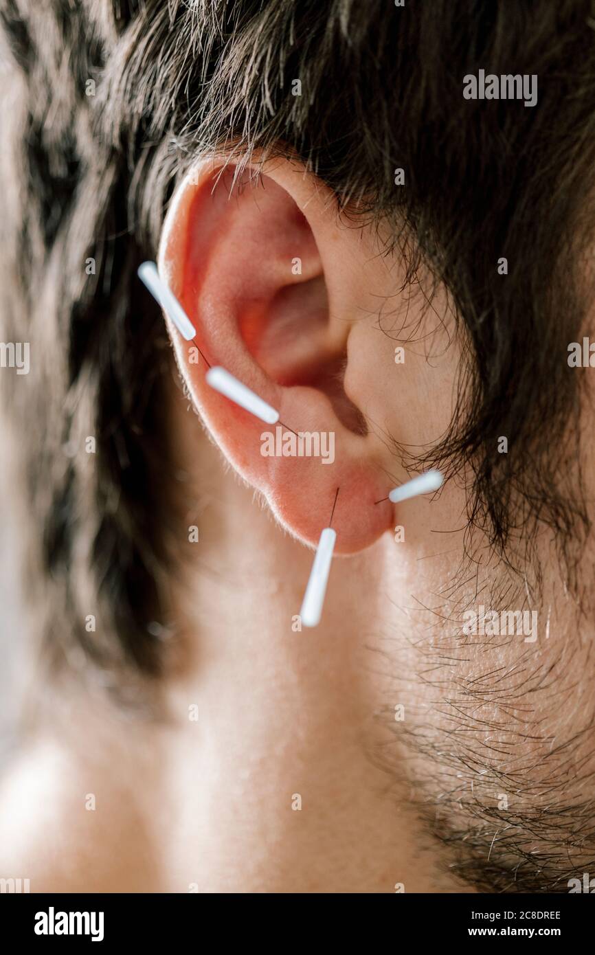 Traditionelle Chinesische Medizin, TCM, Akupunktur, Ohr mit Akupunkturnadel während der Behandlung Stockfoto