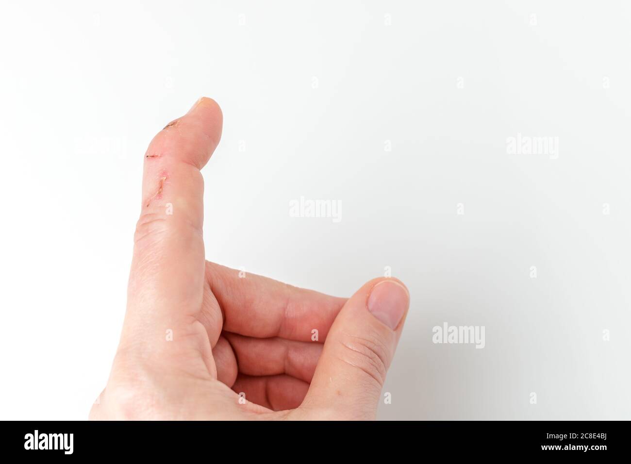 Zeigefinger mit einer Dehnungssehnenverletzung schneiden, Hammerfinger,  Fingerspitze nach unten beugen, während der Rest des Fingers gerade  bleiben, Deformität im letzten Phalangealknochen, nicht abknicken können  Stockfotografie - Alamy