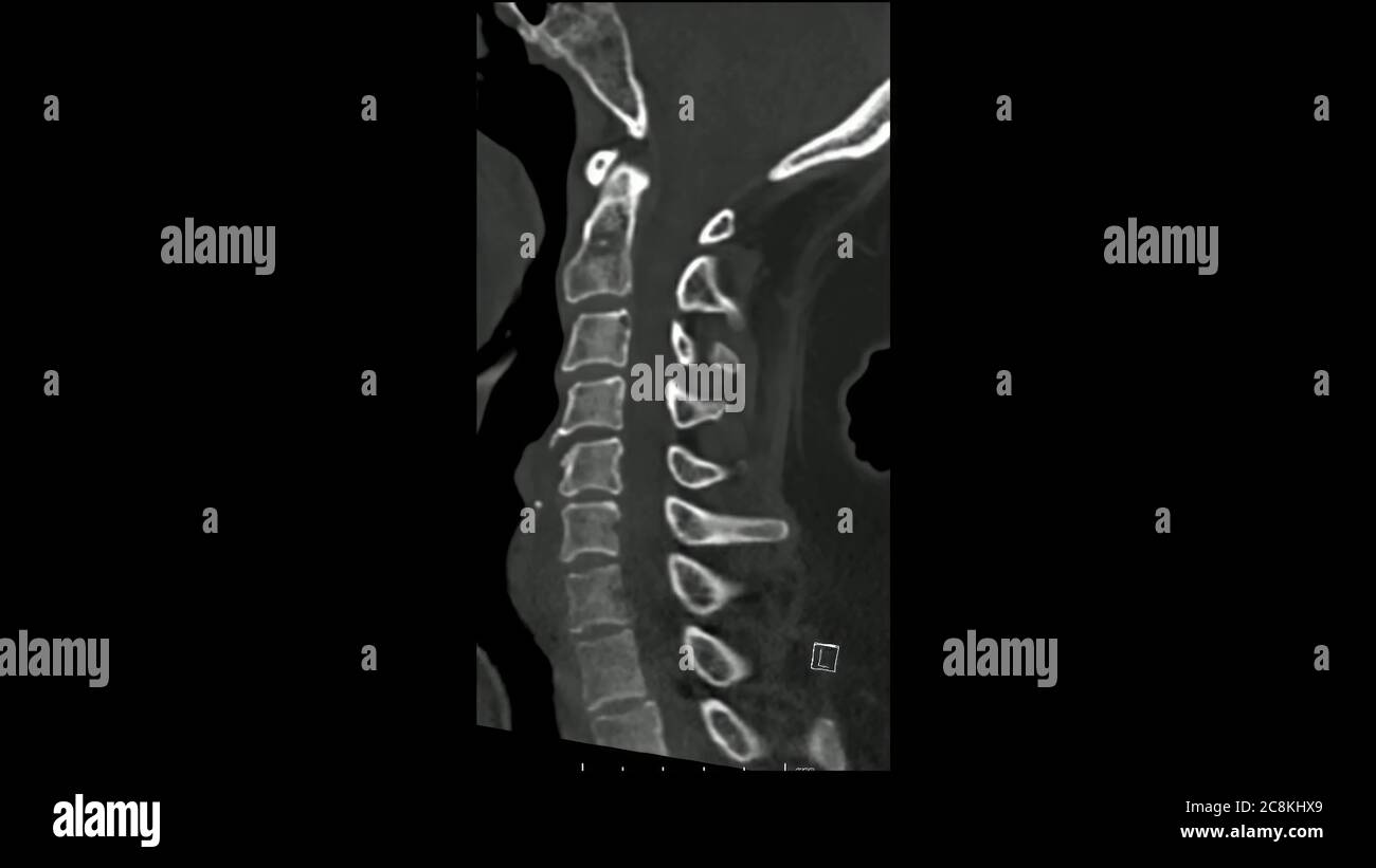 Computertomographie der Halswirbelsäule (CT CS) sagittal im Cine-Modus Stockfoto