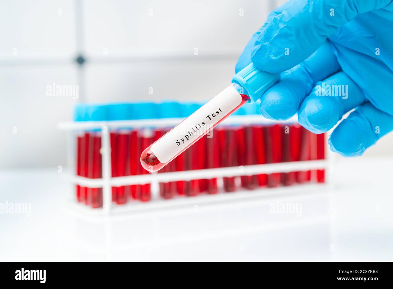 Blutprobe Reagenzglas in der Hand des Arztes für Geschlechtskrankheiten Syphilis Stockfoto