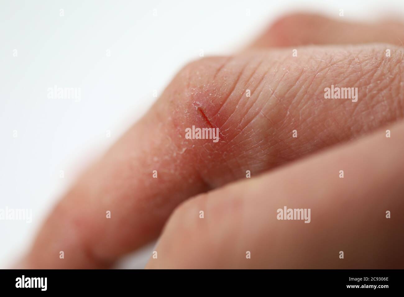 Finger mit geschädigter Haut Nahaufnahme Stockfoto