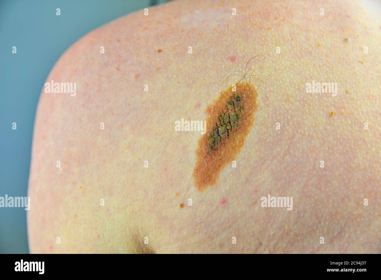 Makroaufnahme der gutartigen Hautläsion. Proliferation von Pigment-Derma-Zellen, melanozytären pigmentierten Naevus, naevozytären Nevus. Mole oder Melanom schwarze Farbe Stockfoto