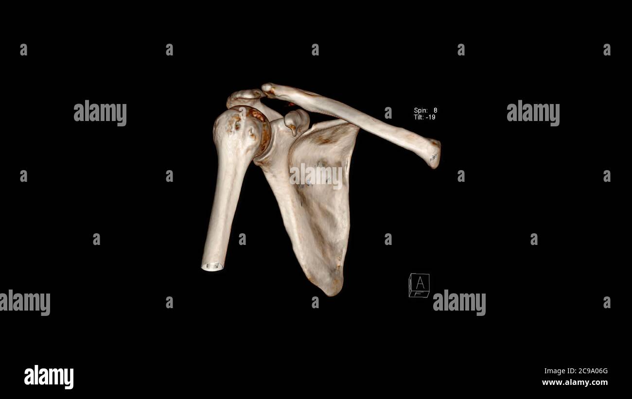 Computertomographie Volumendarstellung Untersuchung der Schulter ( CT VR Schulter). 3D-Rendering Stockfoto