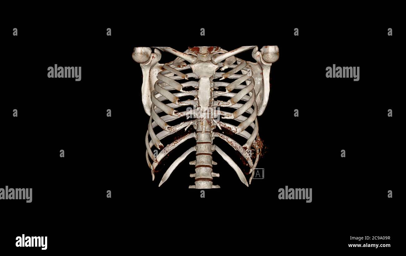Computertomographie Volumendarbietung Untersuchung des Brustkorbs ( CT VR Thoraxkäfig). 3D-Rendering Stockfoto