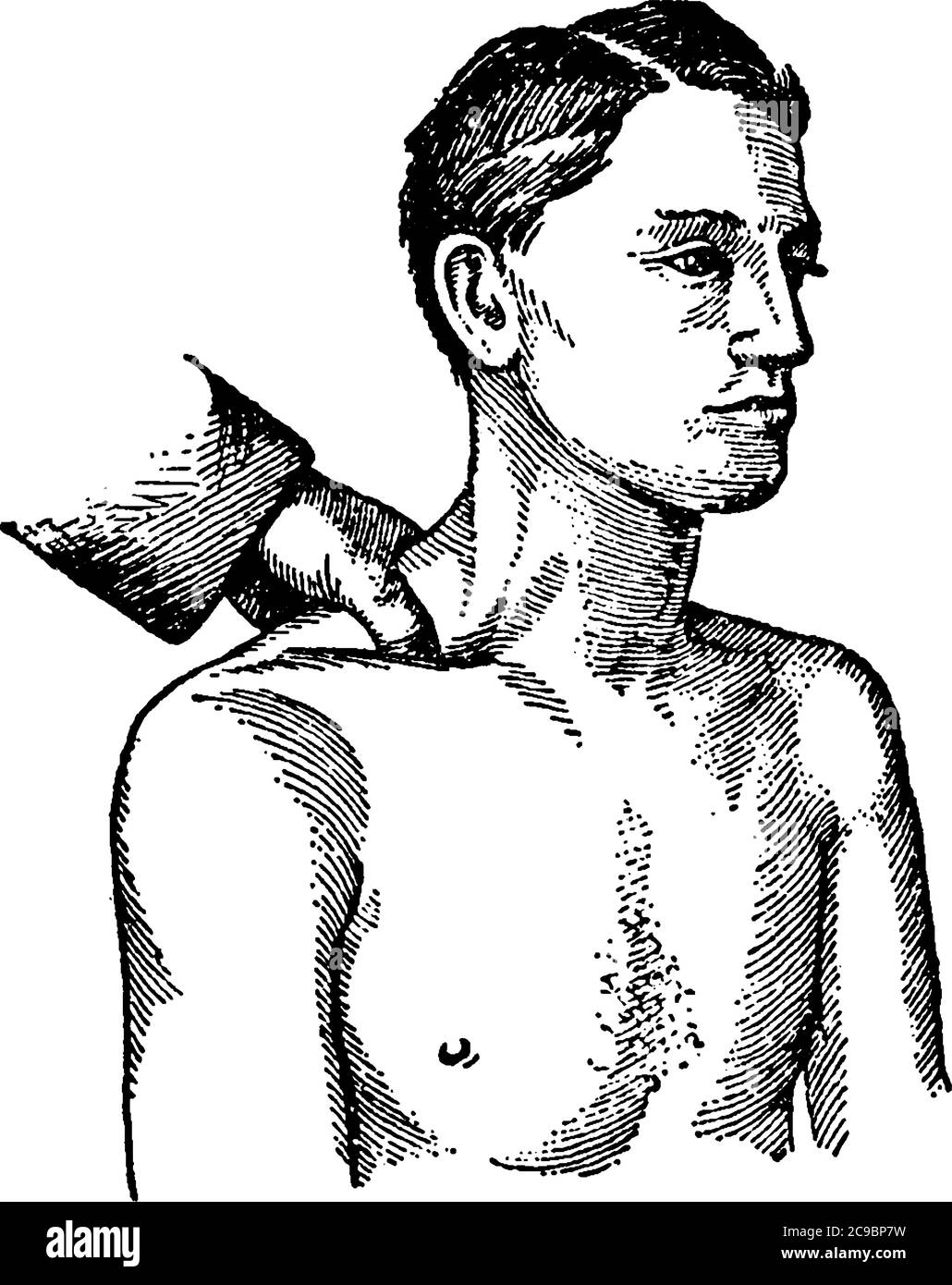 Stellt subclavia Kompression, bei Blutungen aus Wunden der Schulter oder Achsel die subclavia Arterie erreicht werden kann, indem Sie den Daumen tief Stock Vektor