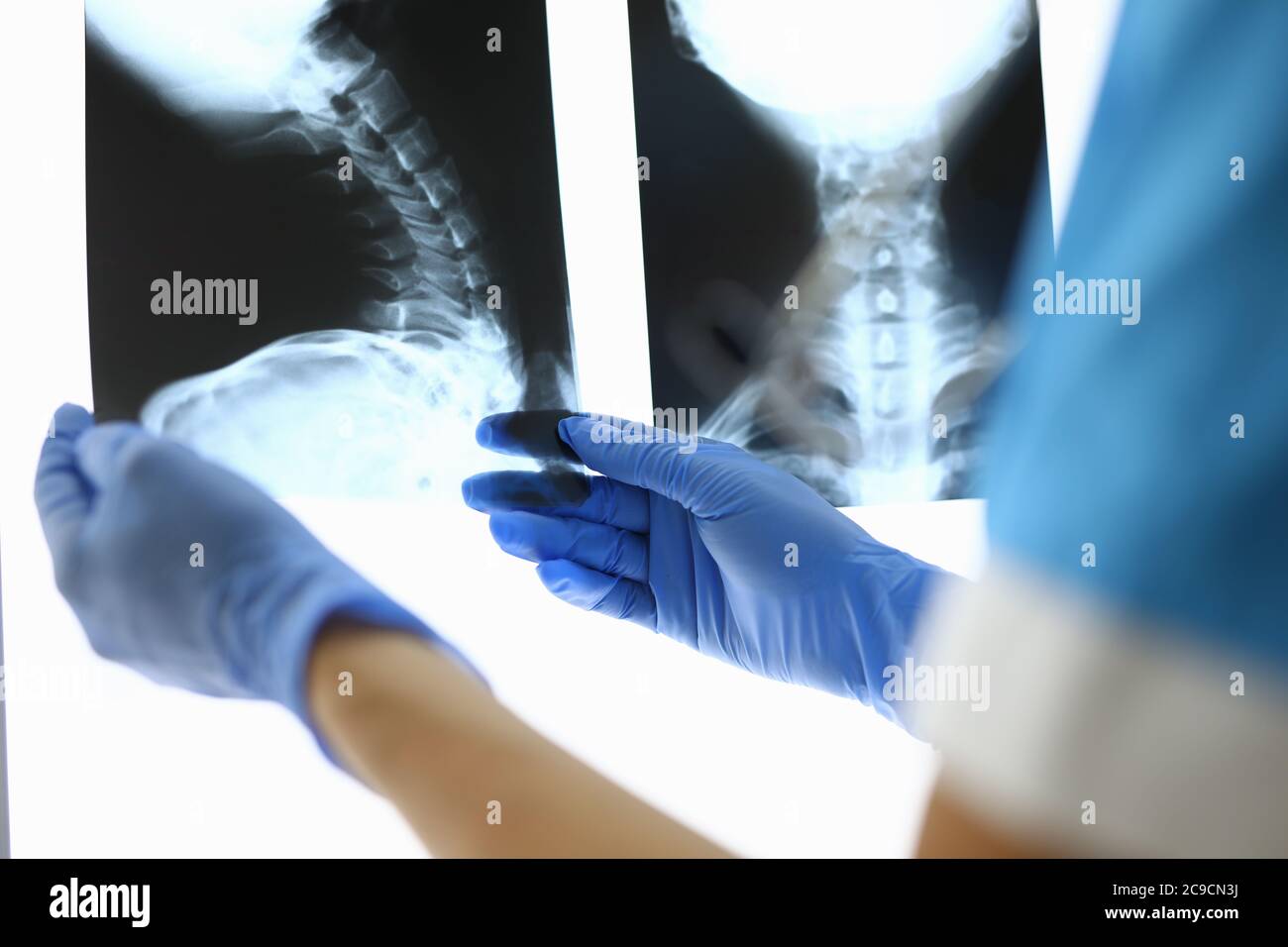 Die Hände des Arztes in Handschuhen halten Röntgenstrahlen von Knochen Stockfoto