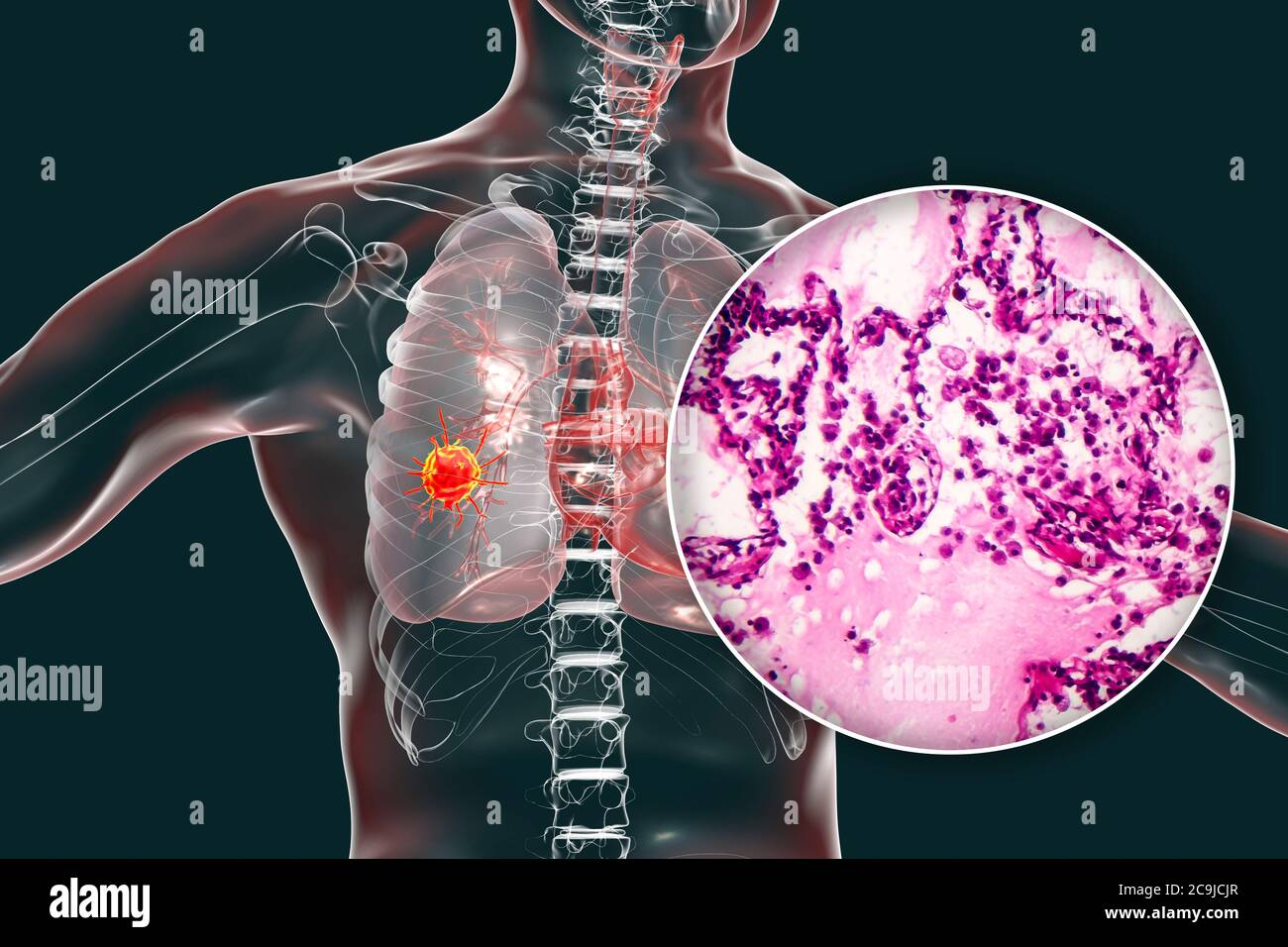 Lungenkrebs, Computerdarstellung und leichte Mikrograph. Leichte Mikrographik mit Adenokarzinom der Lunge. Stockfoto