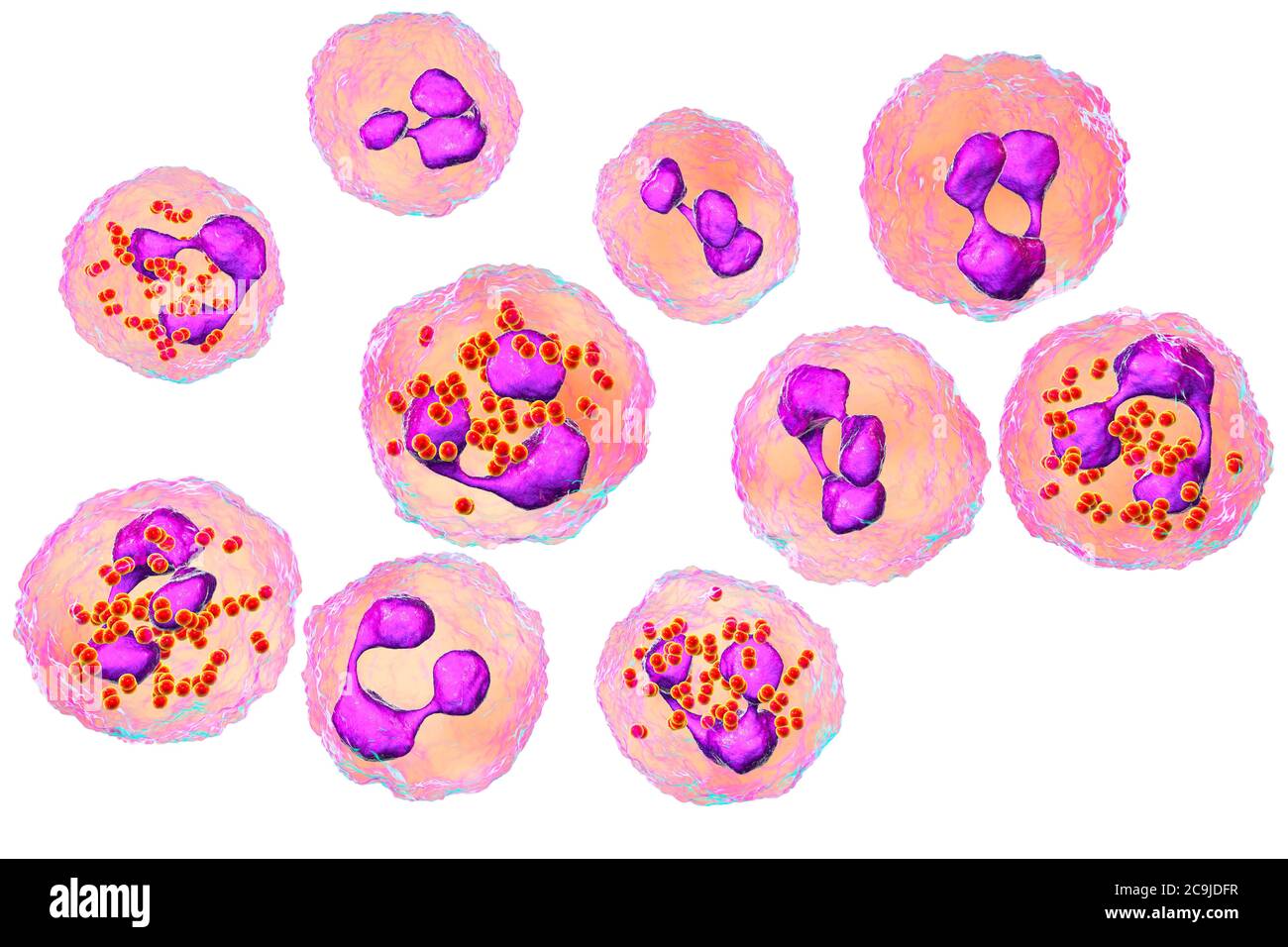 Meningokokken-Meningitis. Computer-Illustration zeigt Liquor mit zahlreichen Neutrophilen mit Neisseria meningitidis Bakterien insid Stockfoto