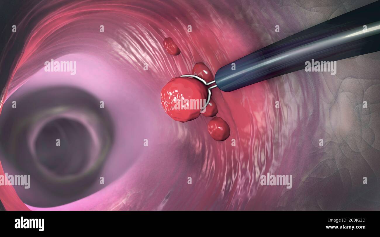 Polypen entfernen, Abbildung. Entfernung eines kolonischen Polypen mit einer elektrischen Drahtschleife während einer Koloskopie. Stockfoto