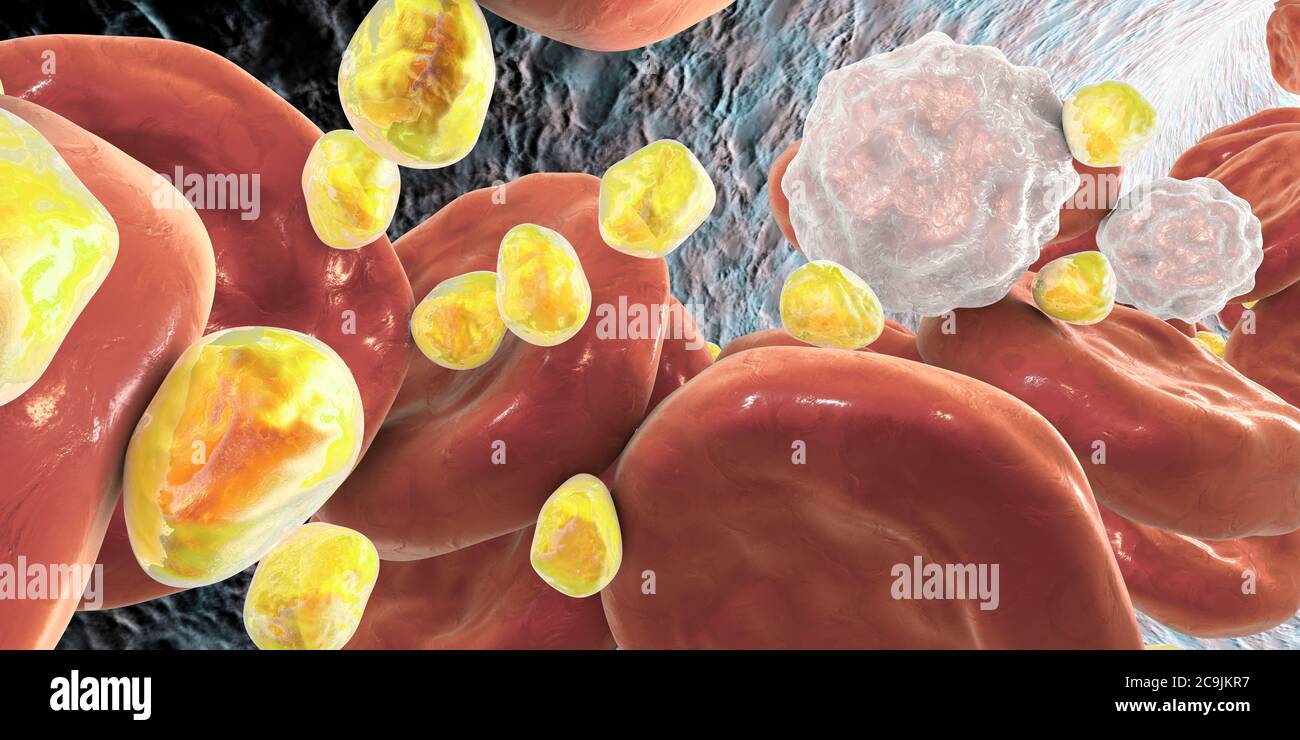 Hoher Cholesterinspiegel. Computerdarstellung von Kugeln des