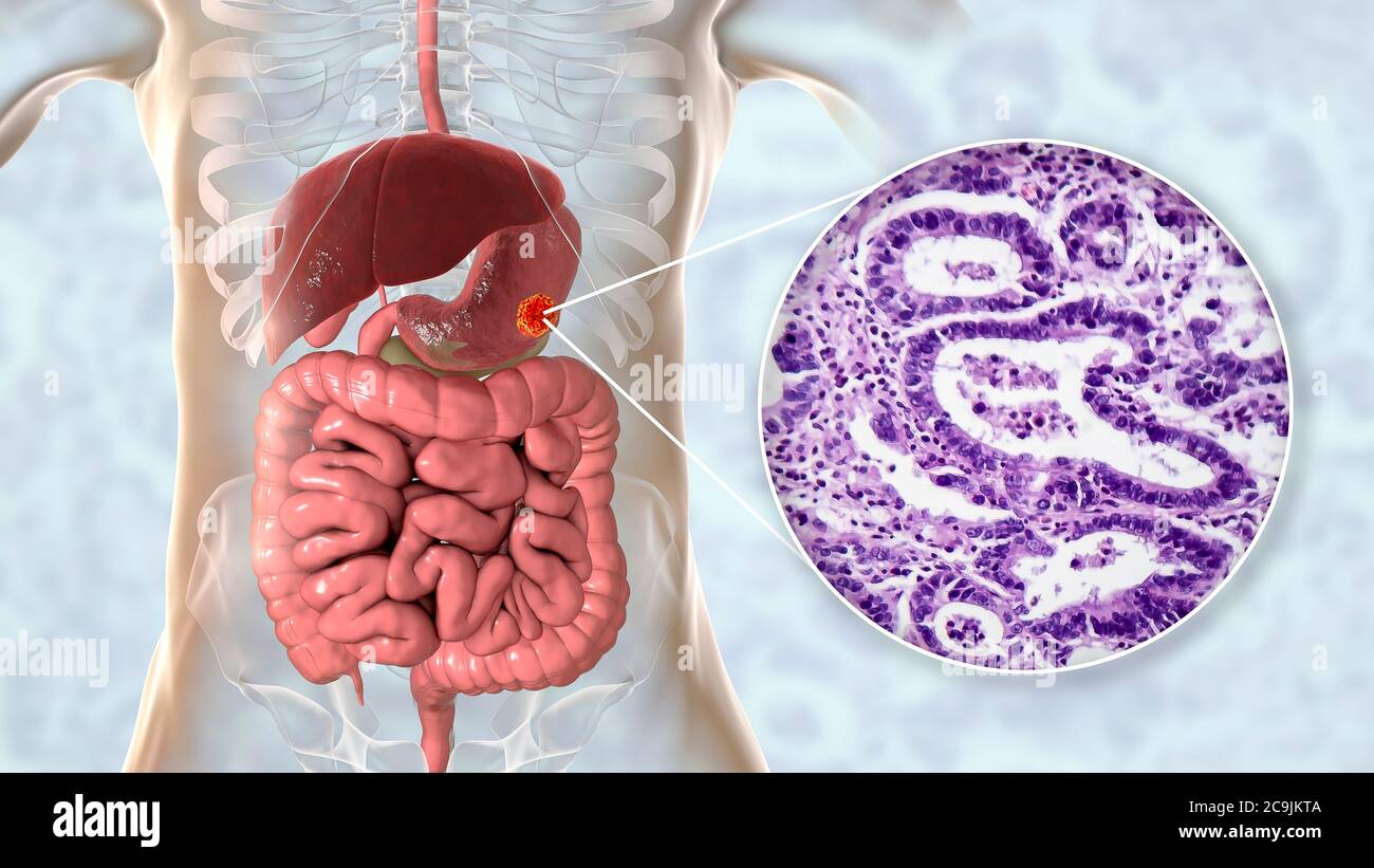 Adenokarzinom des menschlichen Magens, Computerdarstellung und leichte Mikrograph. Stockfoto