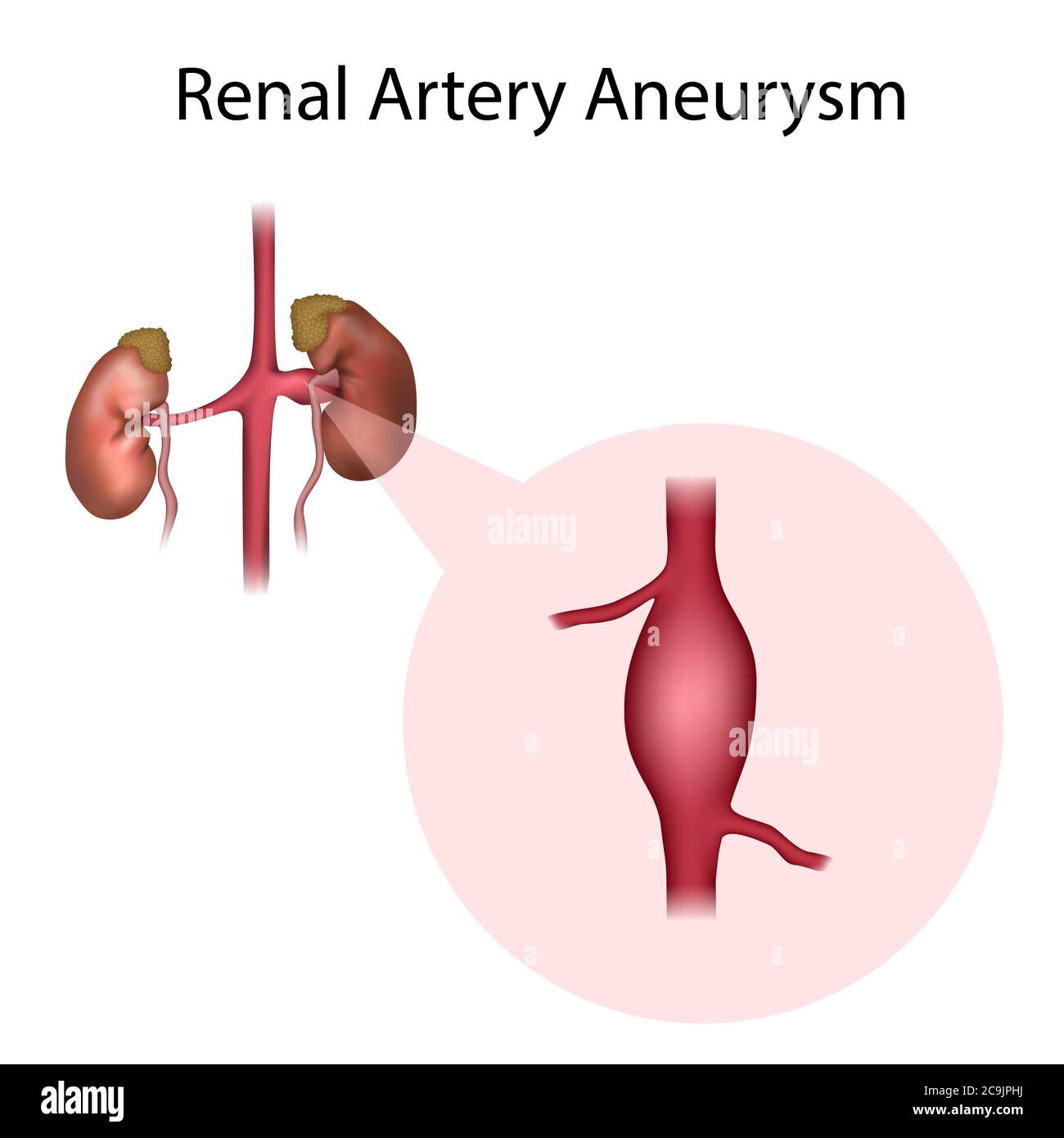 Aneurysma der Nierenarterie, Illustration. Ein Aneurysma ist eine blutgefüllte Dilatation in einem Blutgefäß. Stockfoto