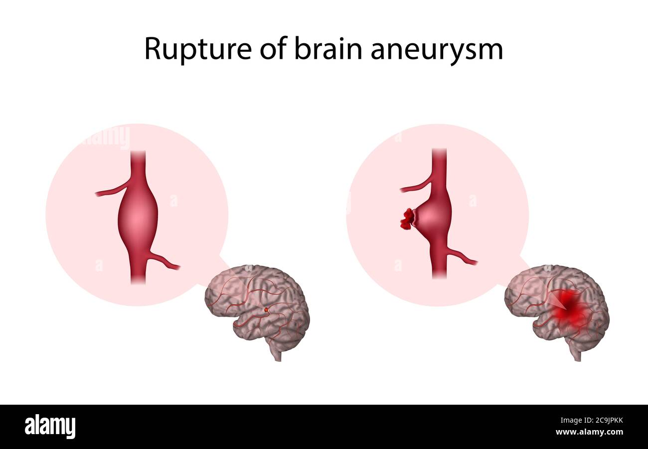 Aneurysma des gebrochenen Gehirns, Illustration. Ein Aneurysma ist eine blutgefüllte Dilatation in einem Blutgefäß. Stockfoto