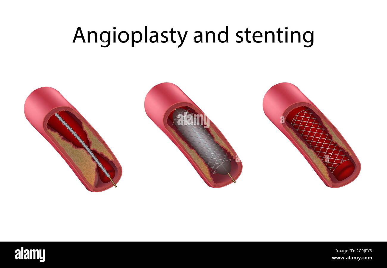 Stadien der angioplastie und stenting Fotos und Bildmaterial in hoher