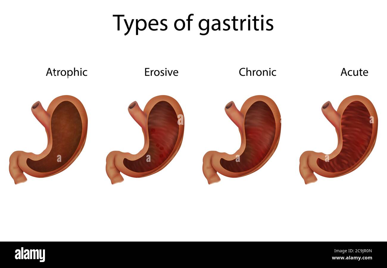 Gastritis akut