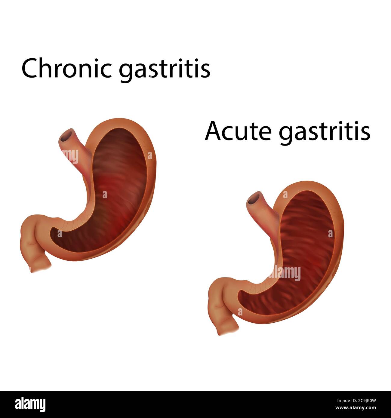 Chronische und akute Gastritis, Illustration. Stockfoto