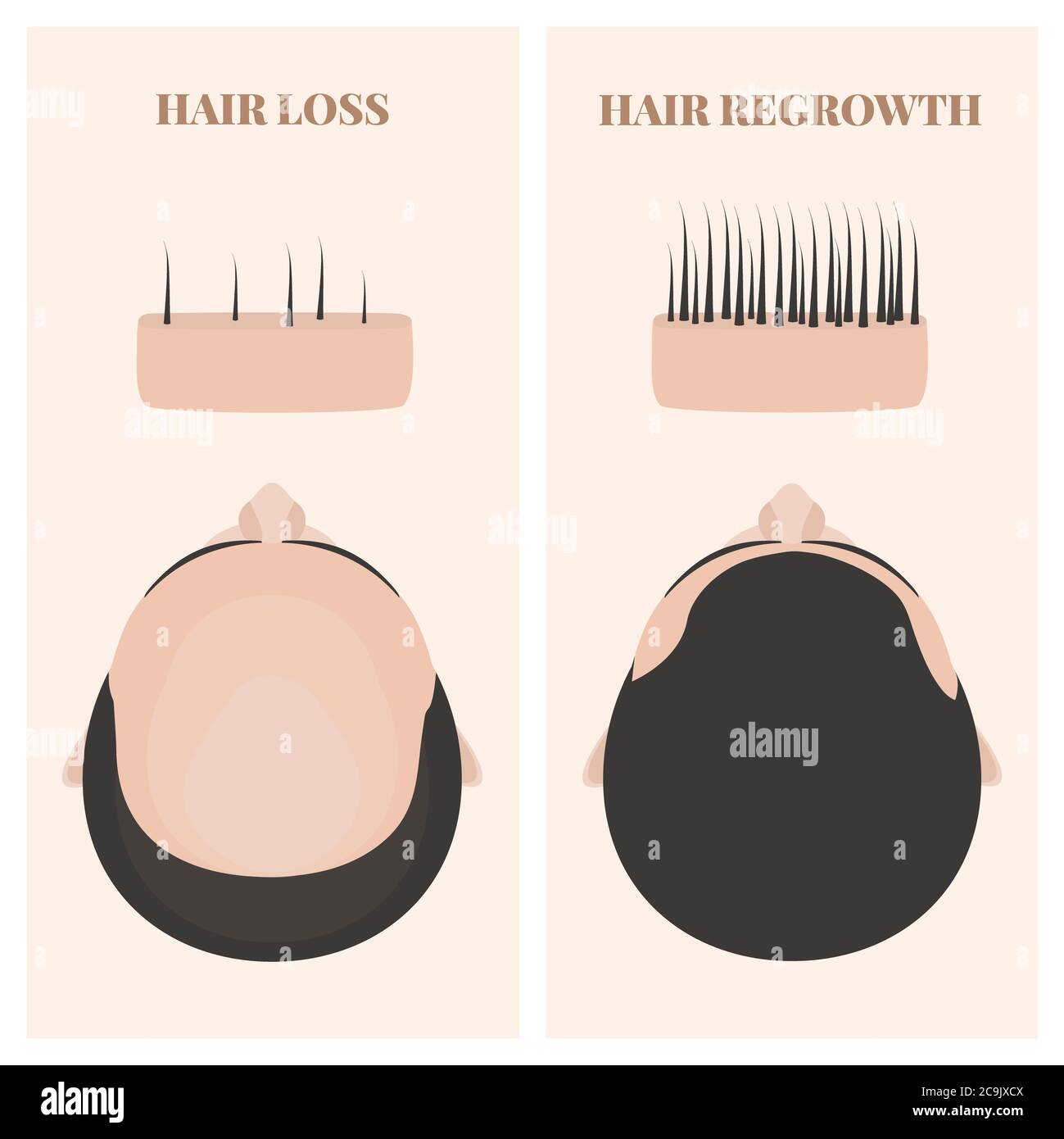 Mann vor und nach der Haartransplantation, Illustration. Stockfoto