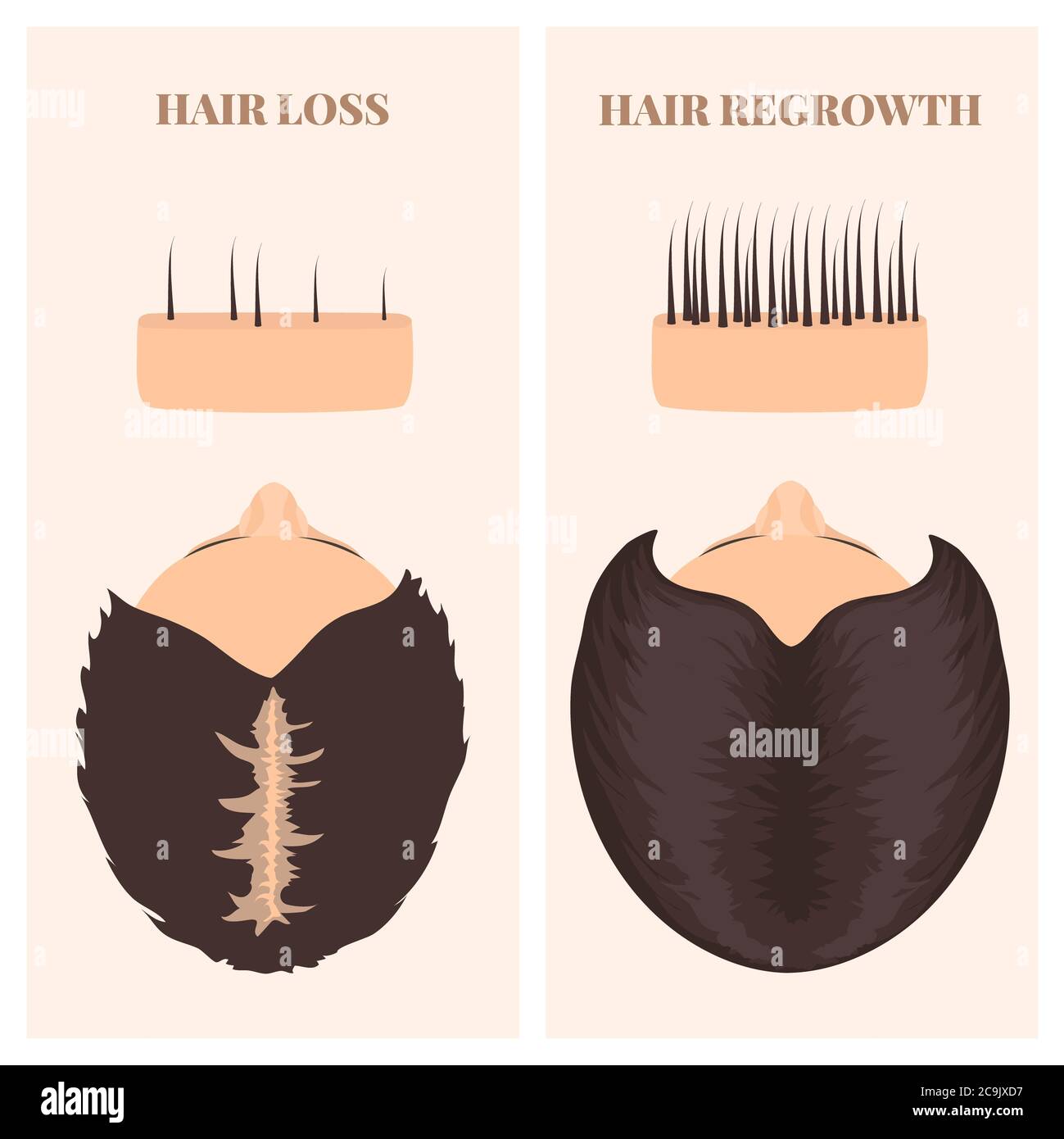 Frau vor und nach der Haartransplantation, Illustration. Stockfoto