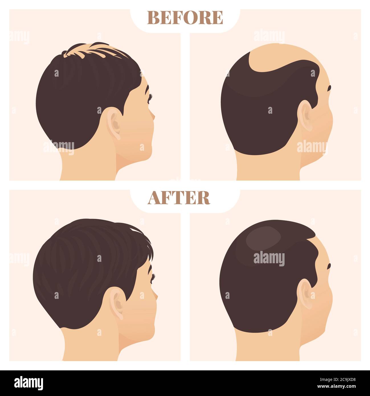 Haarausfall Behandlung führen bei Männern und Frauen, Illustration. Stockfoto