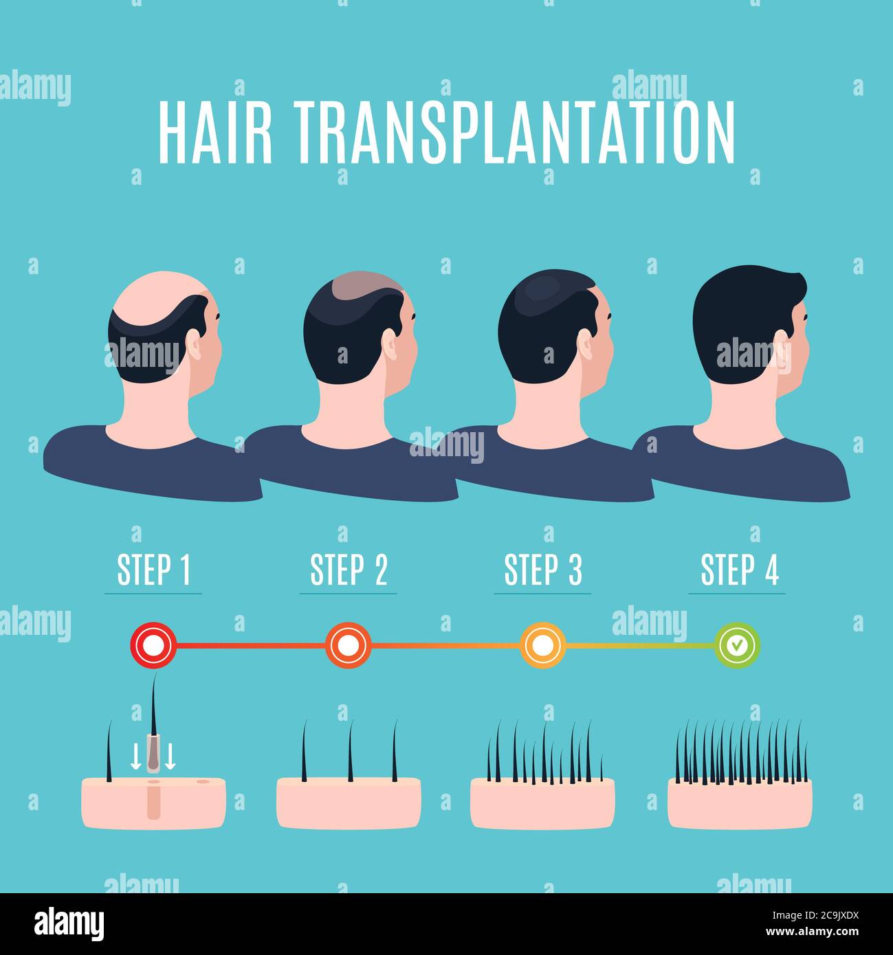 Phasen der Haartransplantation, Illustration. Stockfoto