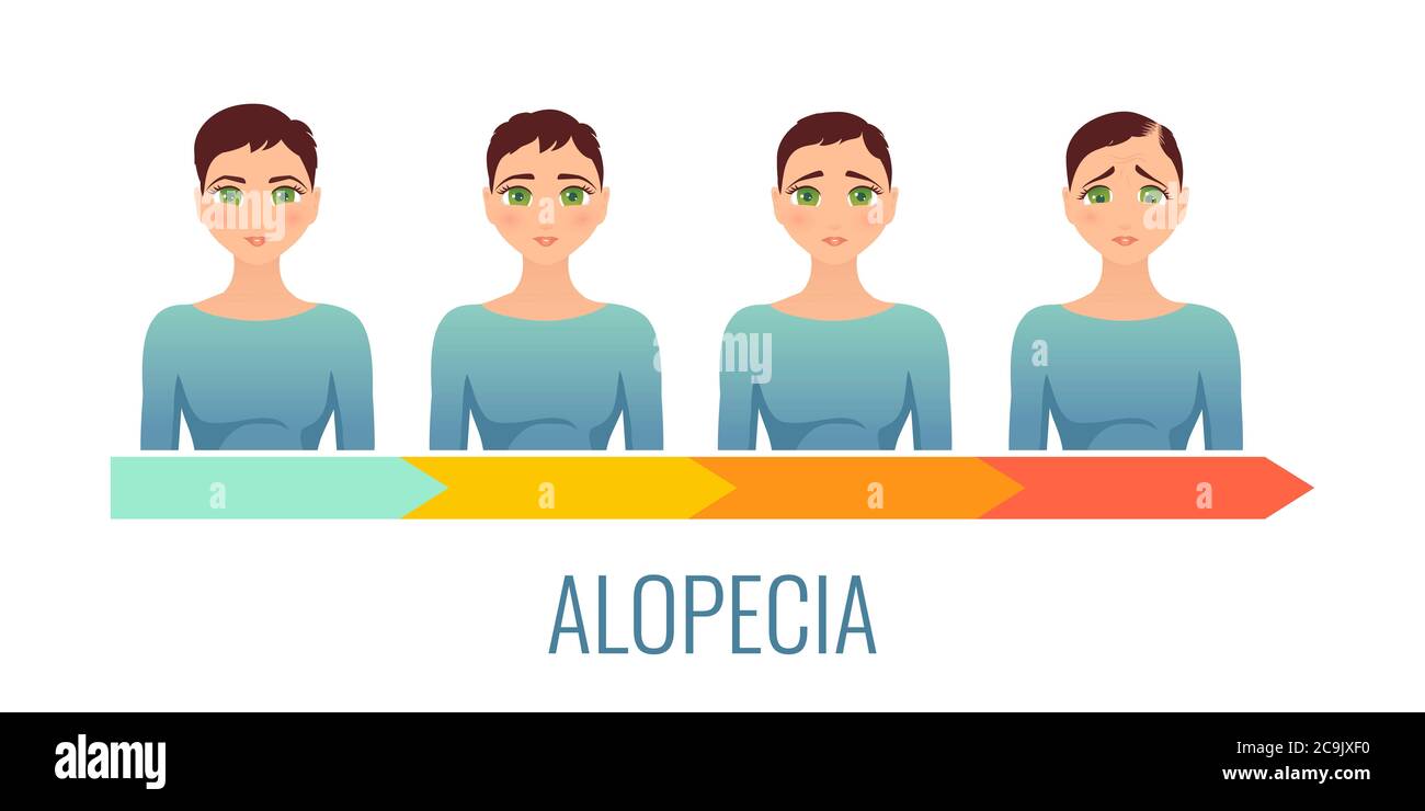 Weibliche Alopezie Stadien, Illustration. Stockfoto