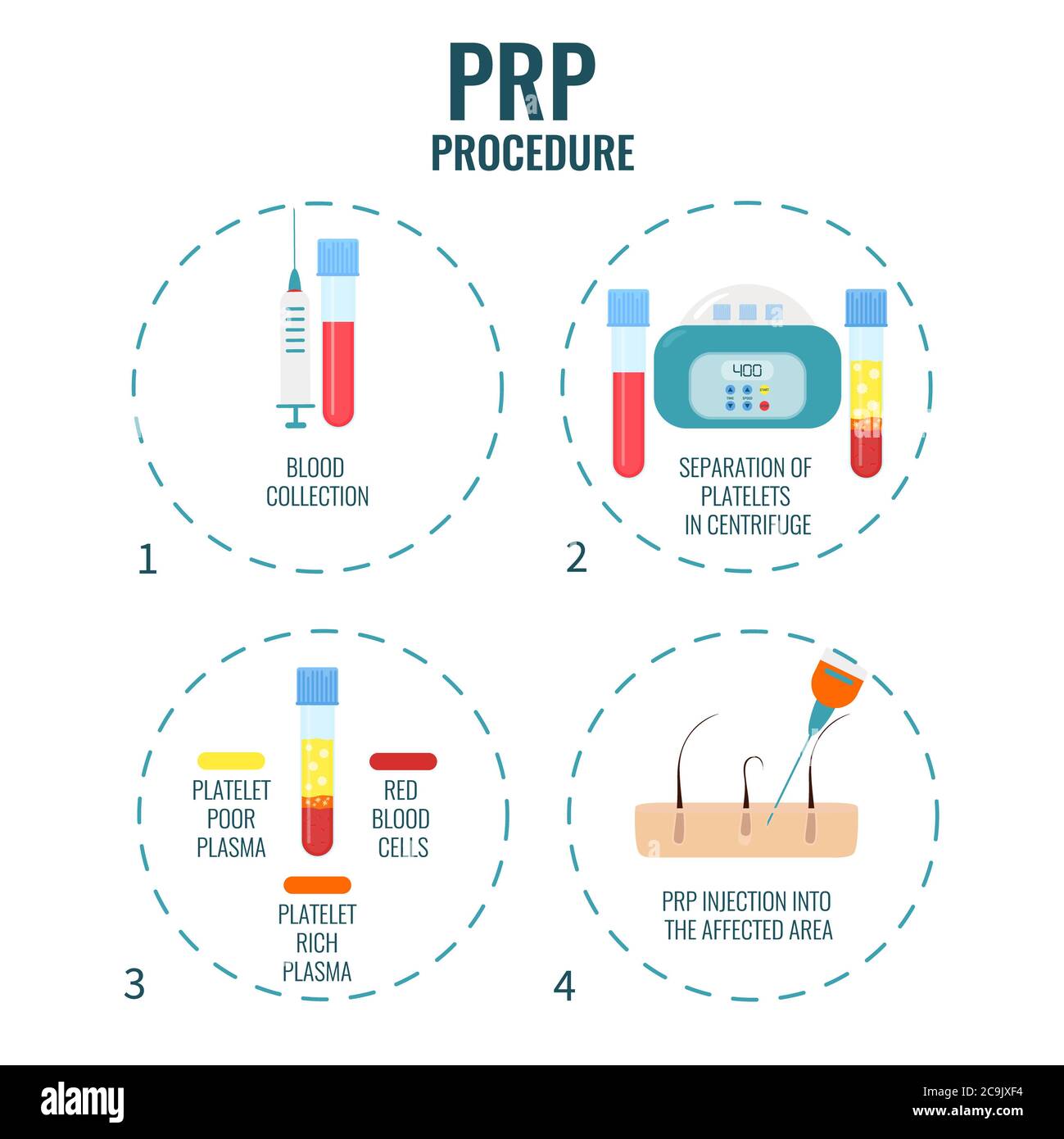 Thrombozytenreiches Plasma (PRP) Haarbehandlung, Illustration. Stockfoto