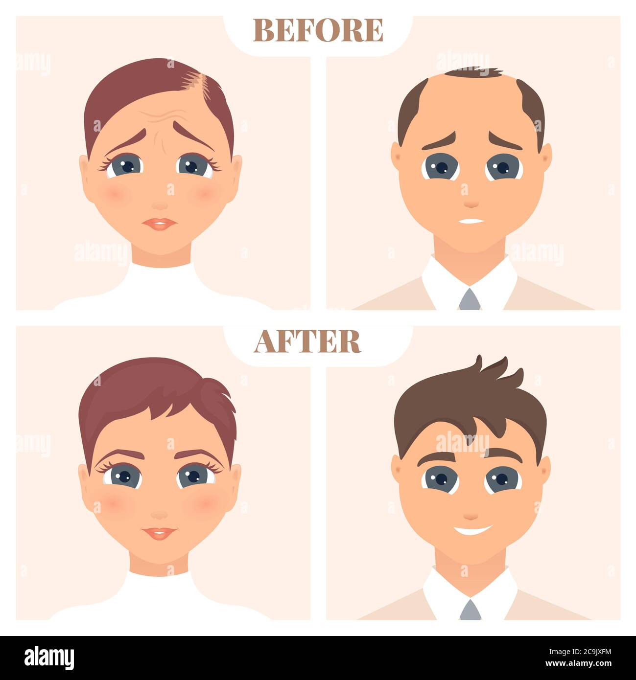 Weibliche und männliche Muster Alopezie, Illustration. Stockfoto