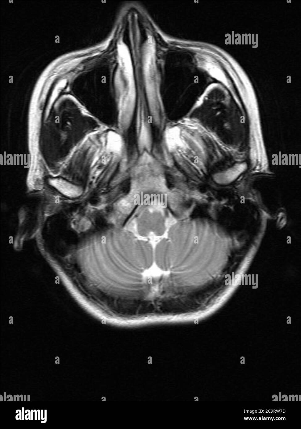 MRT, Magnetresonanztomographie eines gesunden Gehirns einer Frau im Alter von etwa 22 Jahren Stockfoto