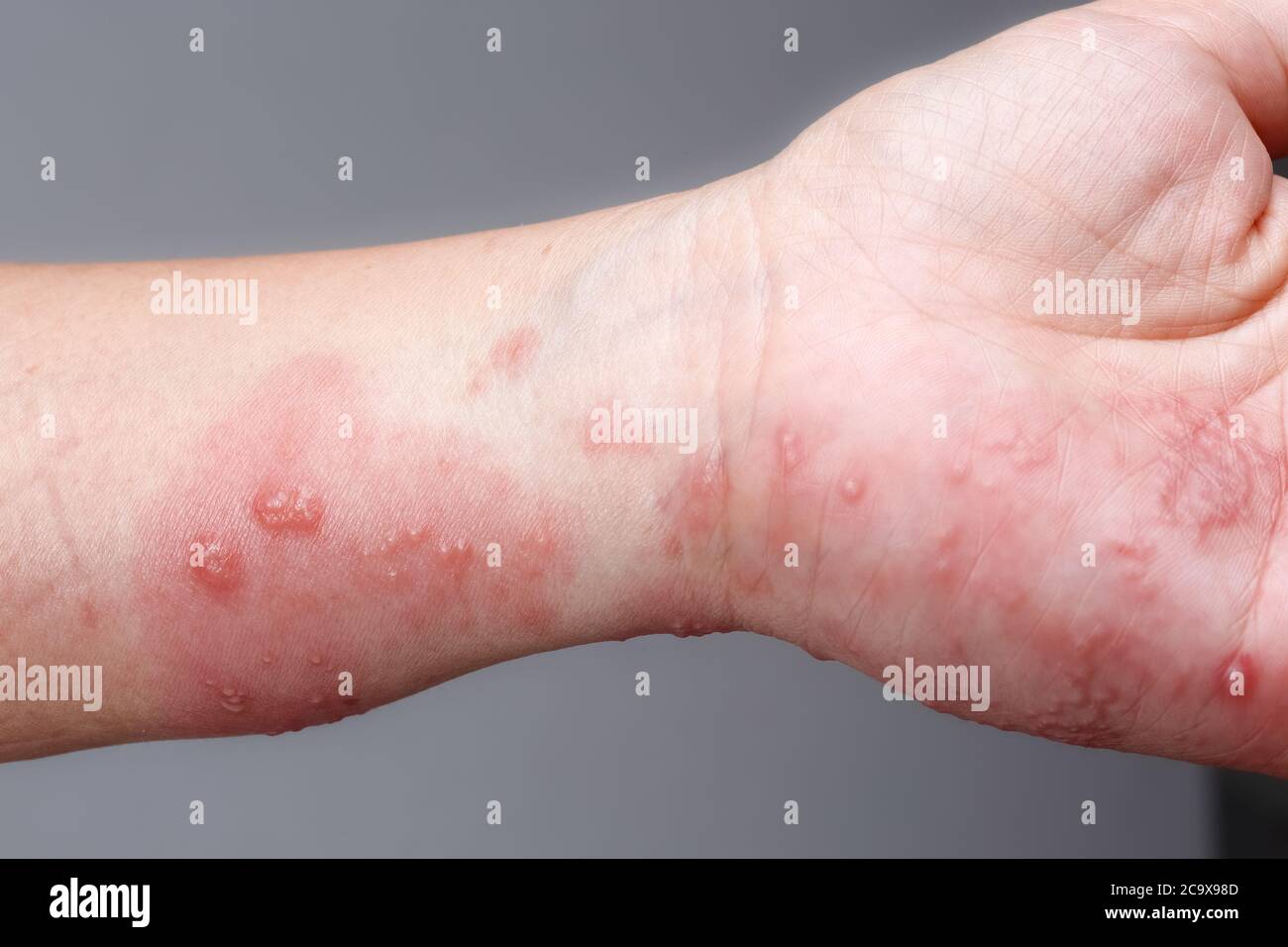 Gürtelrose, Zoster oder Herpes Zoster Symptome am Arm Stockfoto