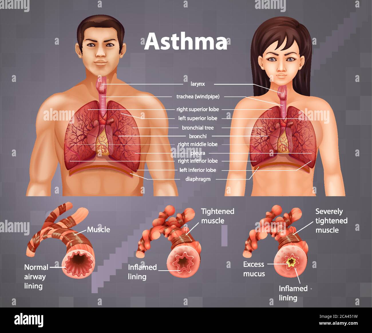 Vergleich von gesunder Lunge und asthmatischer Lunge Abbildung Stock Vektor