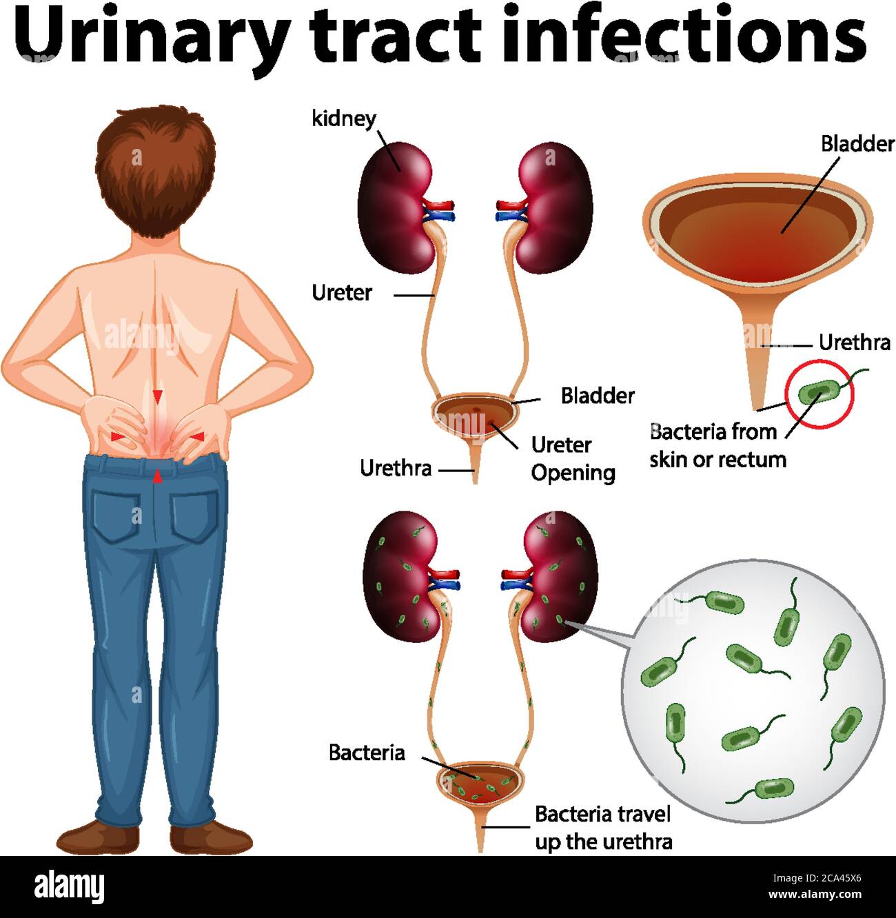 Informative Illustration von Harnwegsinfektionen Illustration Stock Vektor
