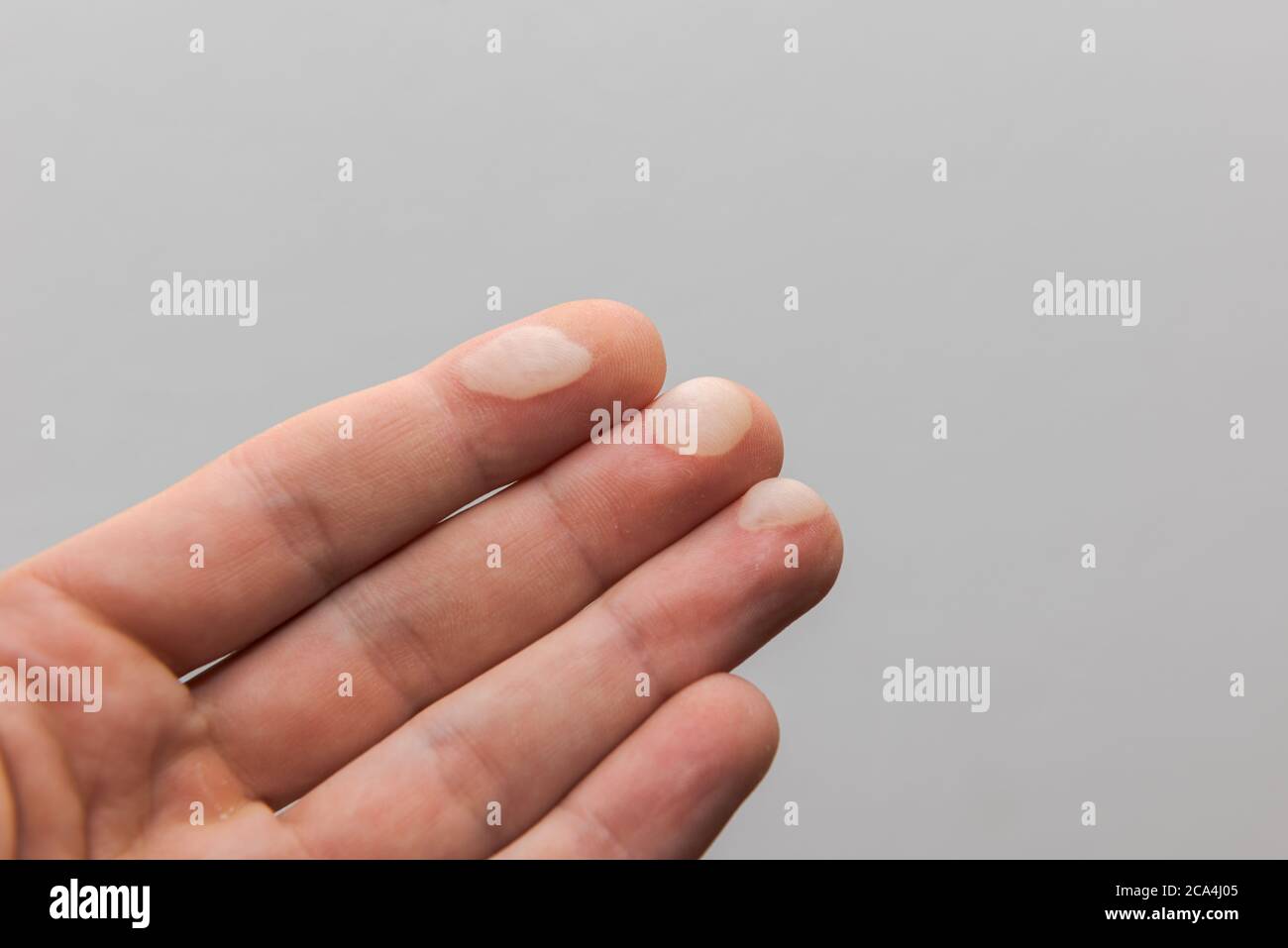 Menschliche Hand mit schmerzhaften Blasen auf drei Fingerspitzen von heißen Pfanne auf weißem Hintergrund isoliert berühren Stockfoto