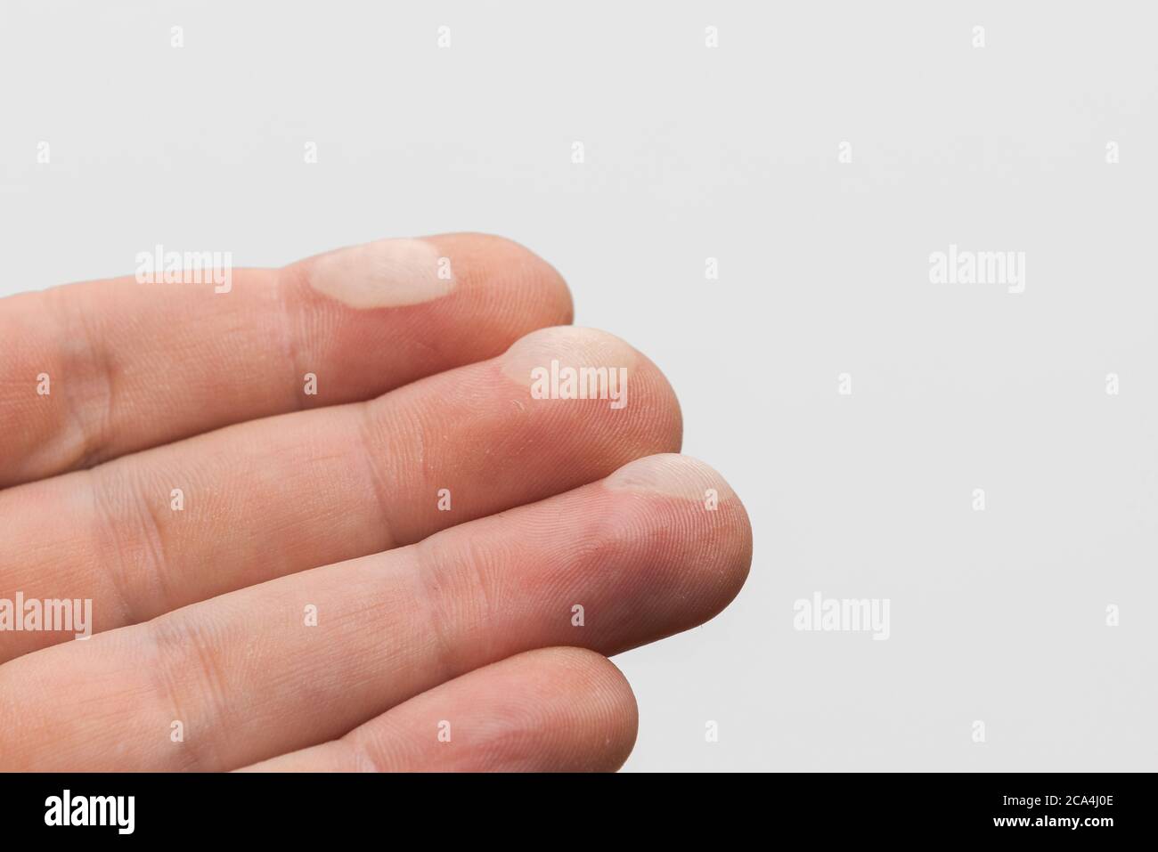 Menschliche Hand mit schmerzhaften Blasen auf drei Fingerspitzen von heißen Pfanne auf weißem Hintergrund isoliert berühren Stockfoto