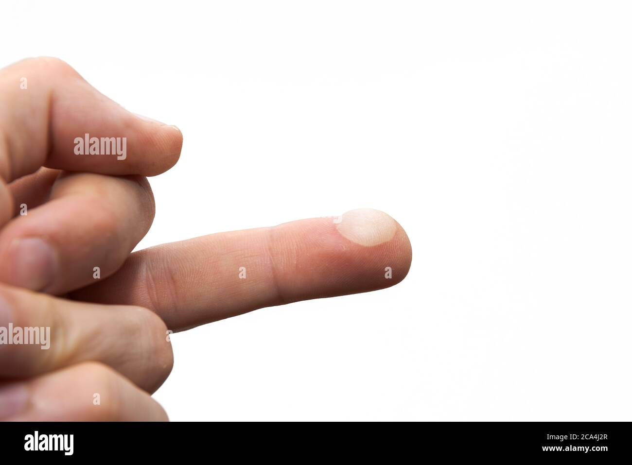 Mittelfinger der menschlichen Hand mit schmerzhaften Blister auf der Fingerspitze von heißen Pfanne auf weißem Hintergrund isoliert berühren Stockfoto