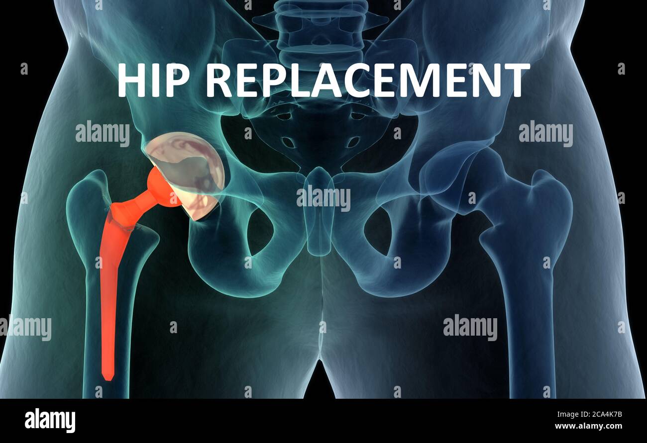 Medizinisch genaue Darstellung des Hüftgelenkersatzes. 3d-Illustration. Stockfoto