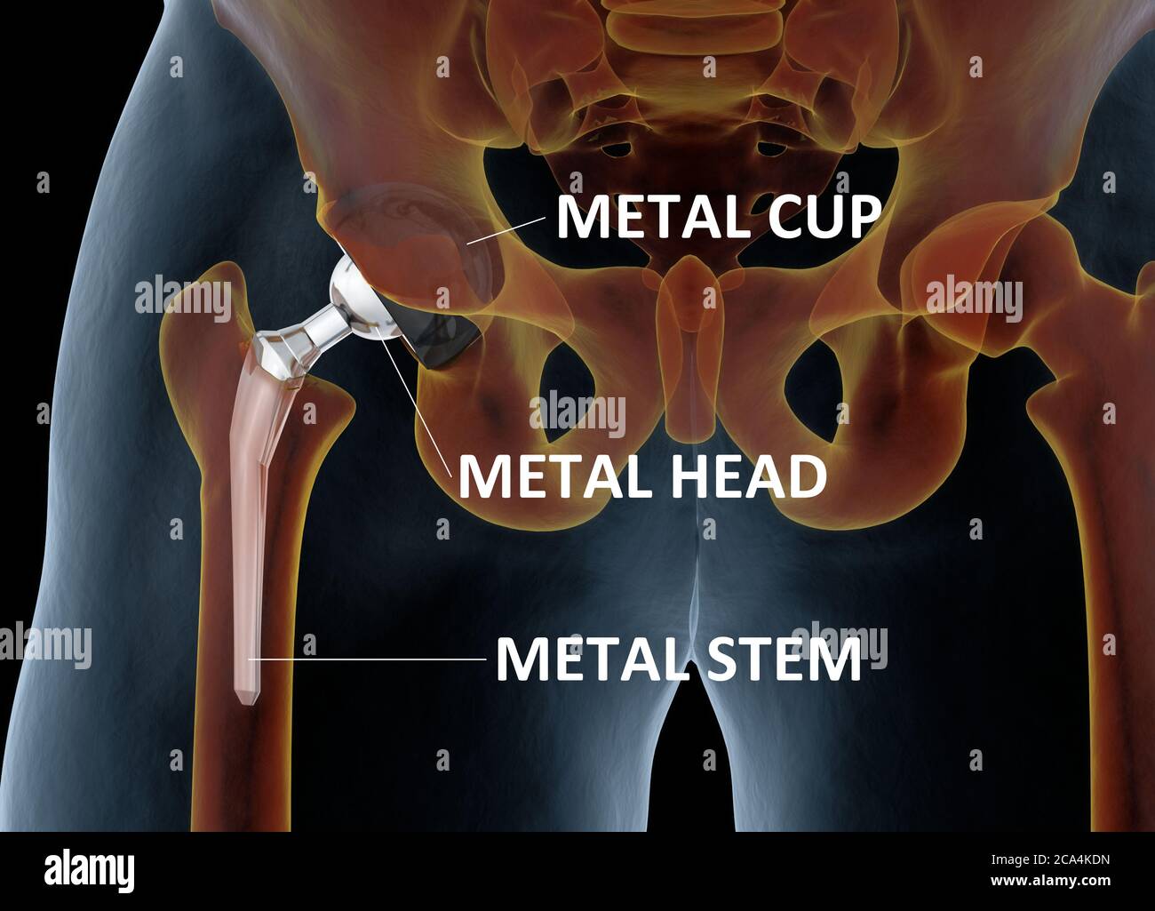 Medizinisch genaue Darstellung des Hüftgelenkersatzes. 3d-Illustration. Stockfoto