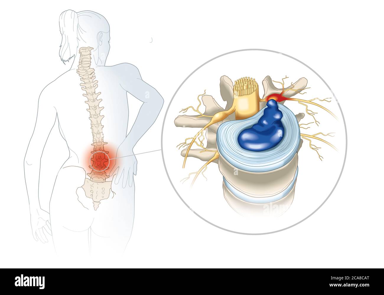 Abbildung zeigt den Wirbelwirbel mit Bandscheibe und einem Zellherniversum pulposus Stockfoto
