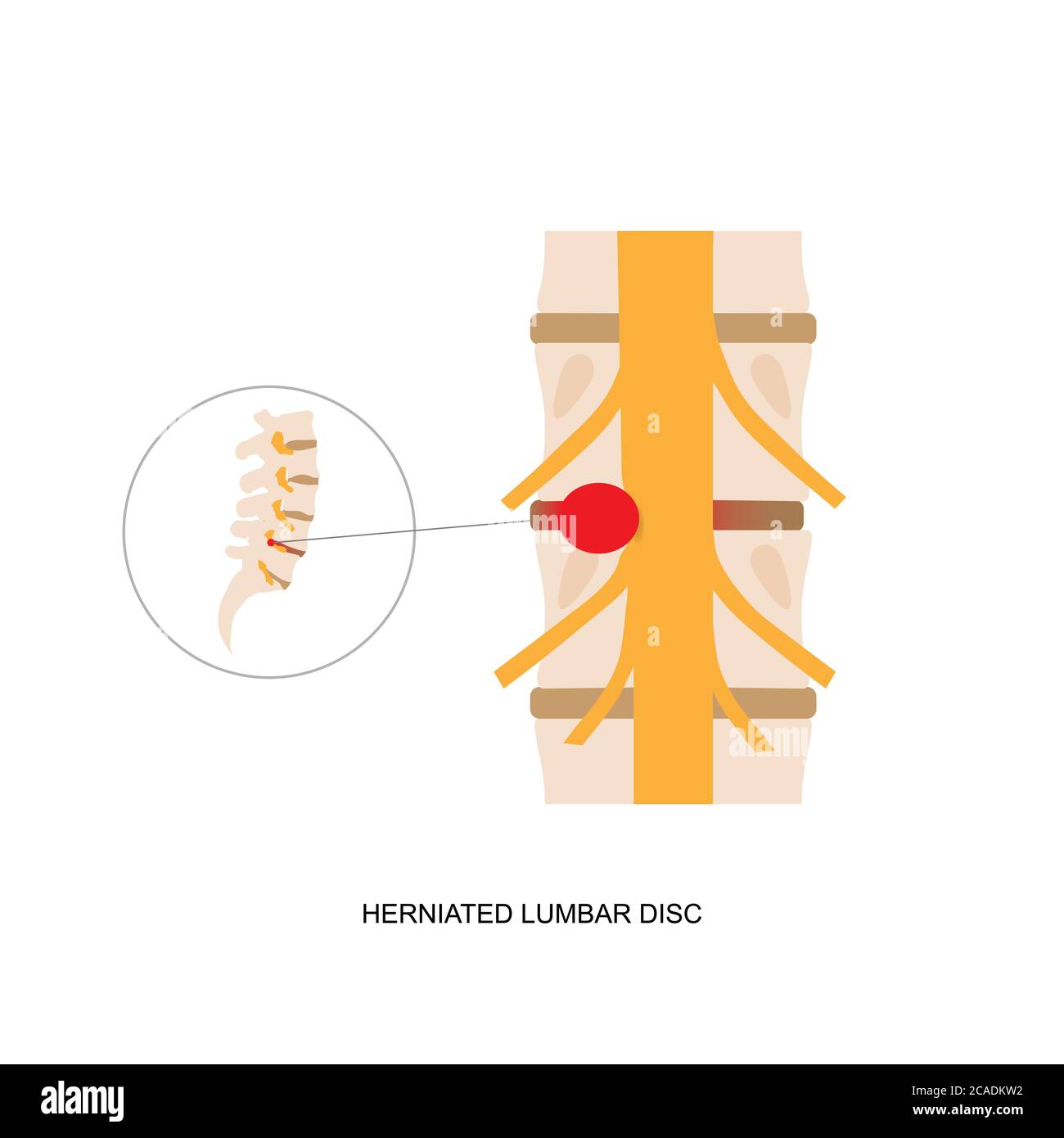 Illustration Demonstration eines menschlichen Bandscheibenvorfalls. Bandscheibenvorfall kann Schmerzen im unteren Rücken und Ischias verursachen Stock Vektor