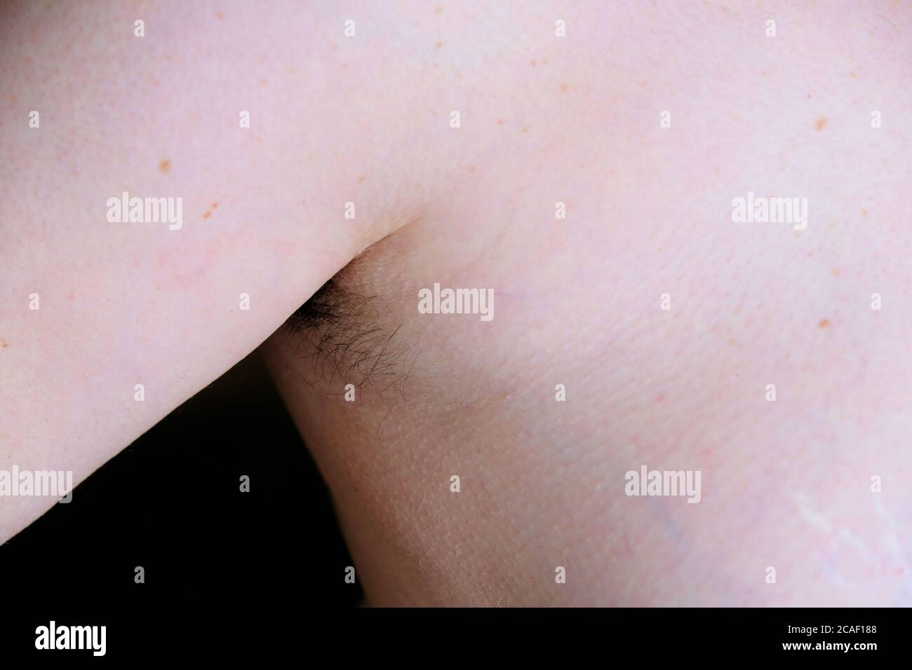 Frau mit Haarwuchs im Achselbereich; Ergebnis der Einquartung während der Coronavirus-Quarantäne; Weibchen mit haariger, unrasierter Achselhöhle. Stockfoto
