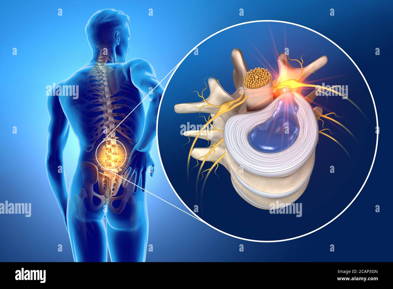 Abbildung zeigt den Wirbelwirbel mit Bandscheibe und einem Zellherniversum pulposus Stockfoto