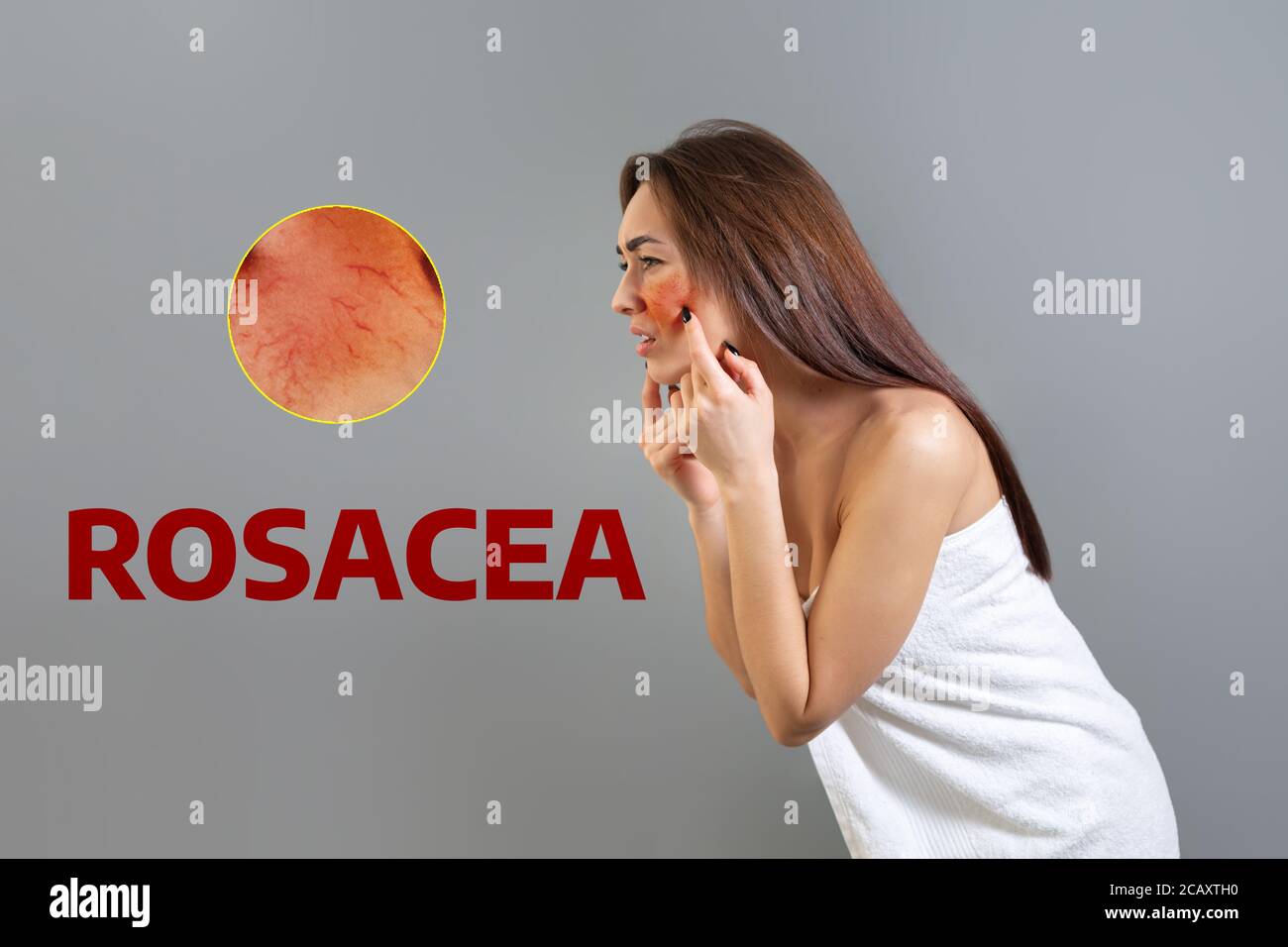 Das Konzept der Rosacea. Eine junge kaukasische Frau stößt ihre rosazea-rote Wange in Frustration. Speicherplatz kopieren. Zoomkreis zeigt Hautprobleme an. Isoliert auf w Stockfoto