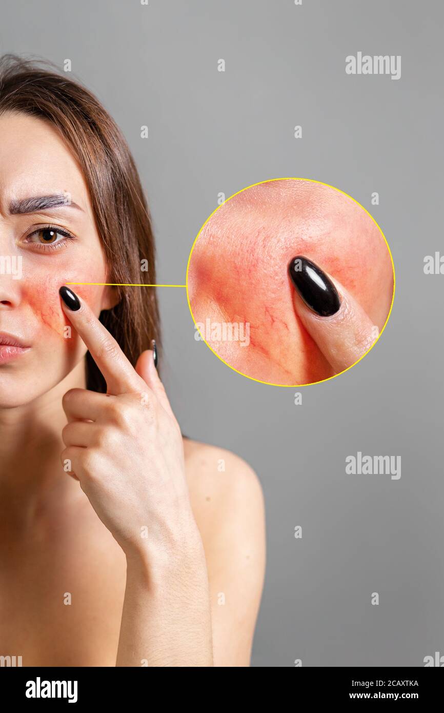 Das Konzept der Rosacea. Eine kaukasische Brünette Frau zeigt einen Finger auf eine rote Wange mit Entzündung. Speicherplatz kopieren. Zoomkreis zeigt Hautprobleme an. Vert Stockfoto