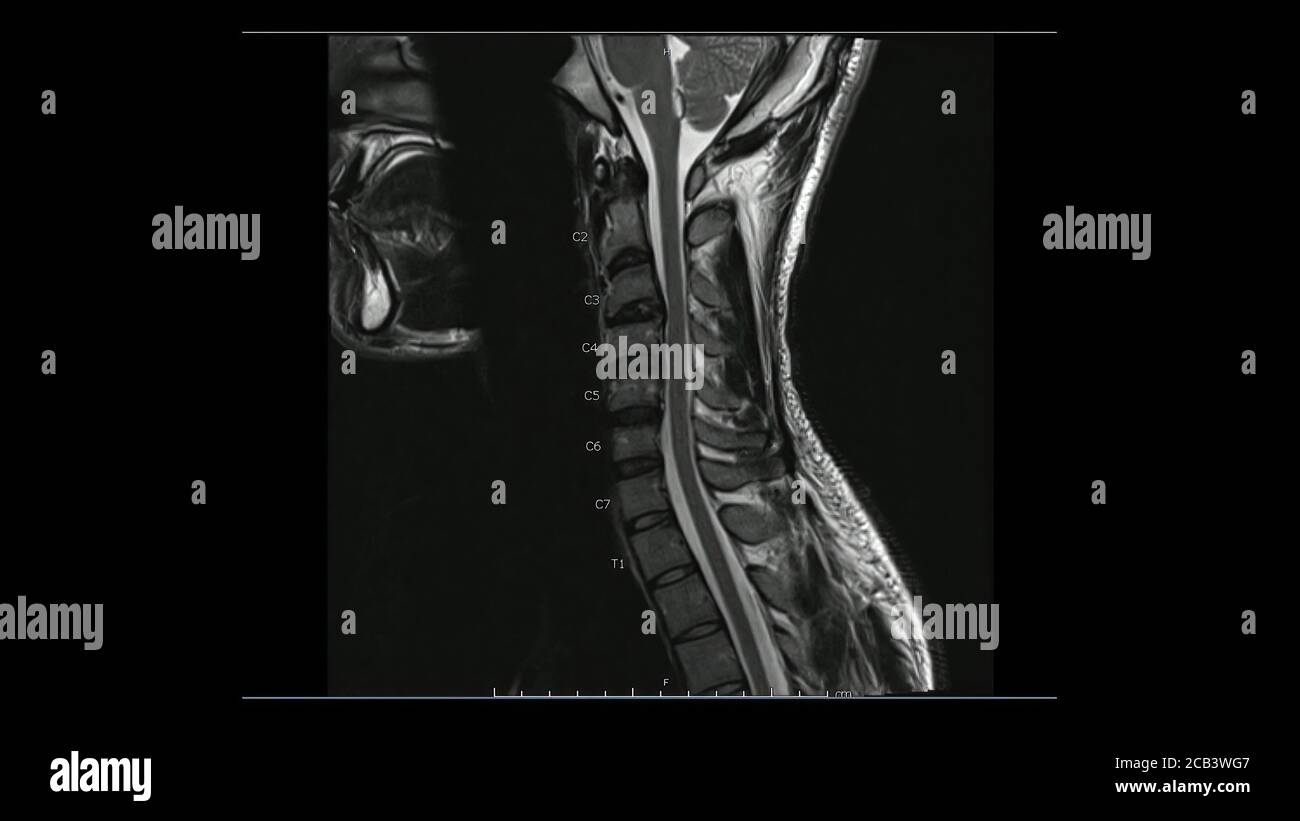 Magnetresonanzbilder der Halswirbelsäule sagittale T2-gewichtete Bilder (MRT-Halswirbelsäule), die eine leichte Bandscheibenerkrankung zeigen. Stockfoto
