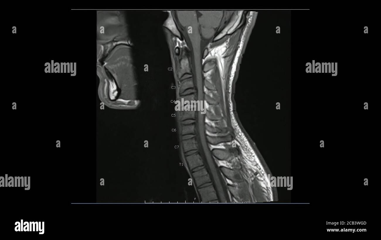 Magnetresonanzbilder der Halswirbelsäule sagittales T1-gewichtetes Bild (MRT-Halswirbelsäule) mit leichter Bandscheibenerkrankung. Stockfoto