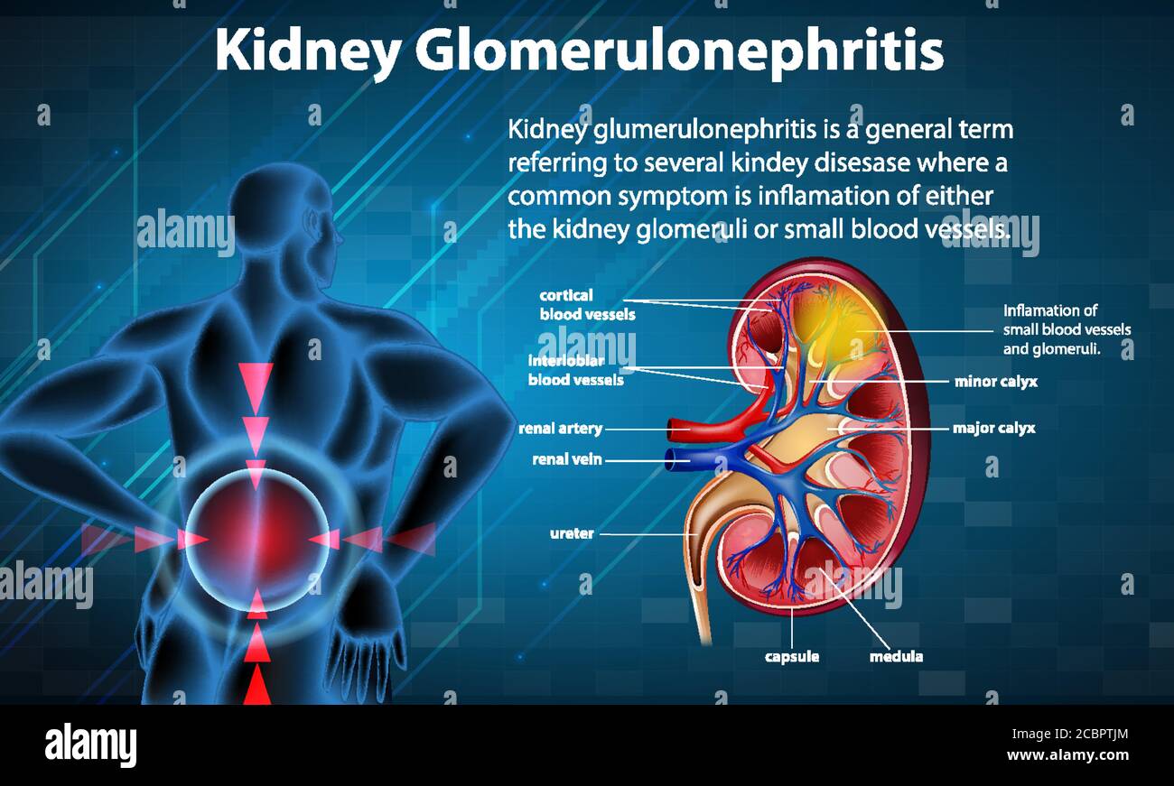 Medizinische Infografik der Niere Glomerulosklerose Illustration Stock Vektor